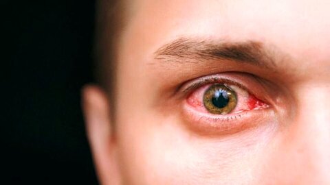 علائم چشمی بیماری کووید-۱۹