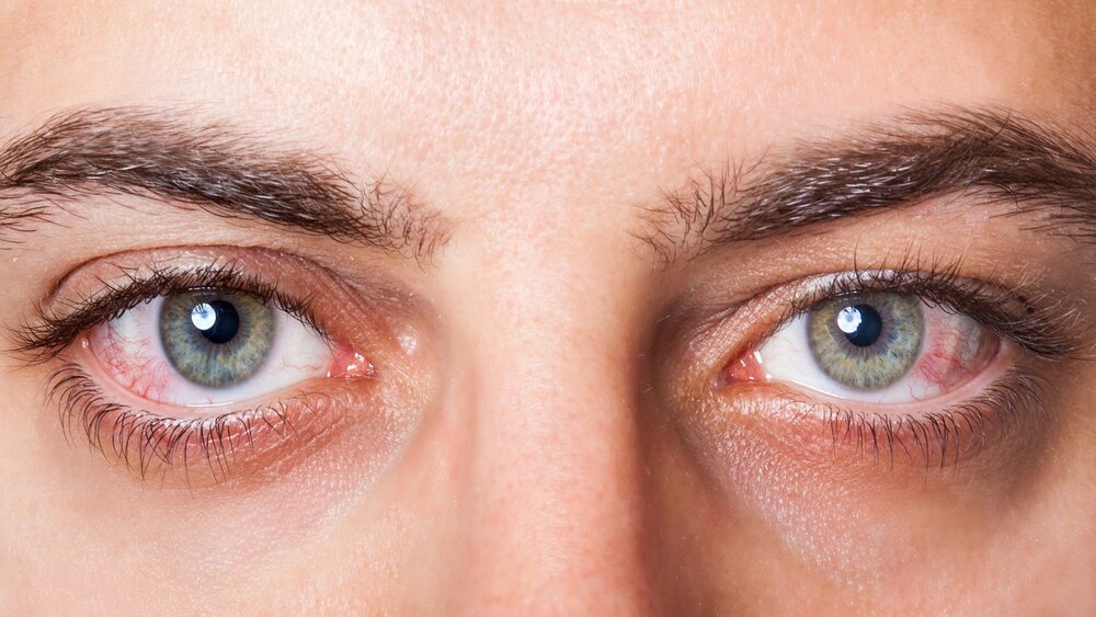 درمان سندرم خشکی چشم ناشی از ماسک زدن
