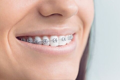 ارتودنسی دندان: انواع براکت دندان، مزایا و عوارض
