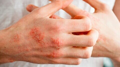 مشکلات پوستی جزو علائم بیماری کووید-۱۹ است