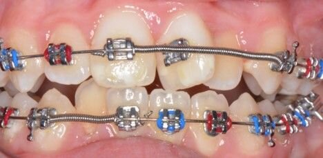 ارتودنسی دندان چه مدت طول می کشد و روش های مراقبت از آن چگونه است؟
