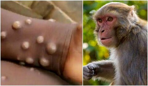 آبله میمون چیست؟ + مسری بودن، علائم و درمان
