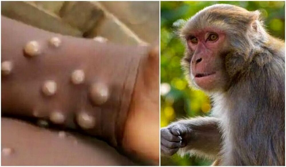 بیماری آبله میمون چه‌قدر قدرت انتقال دارد؟