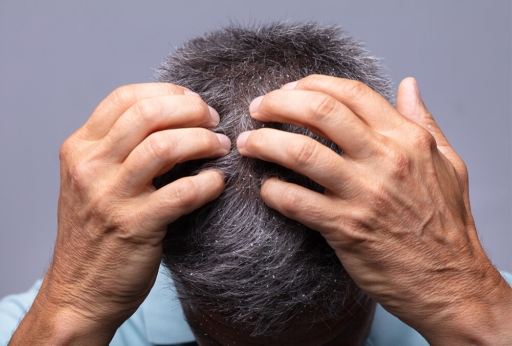 درمان خانگی شوره سر + انواع، علت و راهکارهای درمان پوسته مو