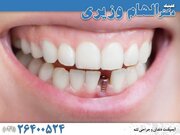 ایمپلنت دندان چیست؟ قیمت و هزینه های آن چقدر است