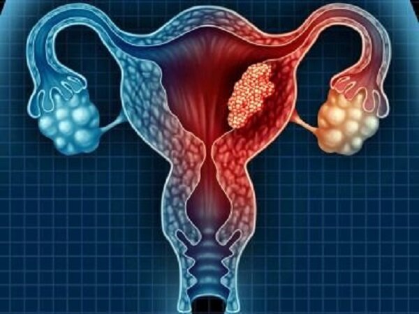 تشخیص انواع سرطان در زنان توسط متخصص زنان