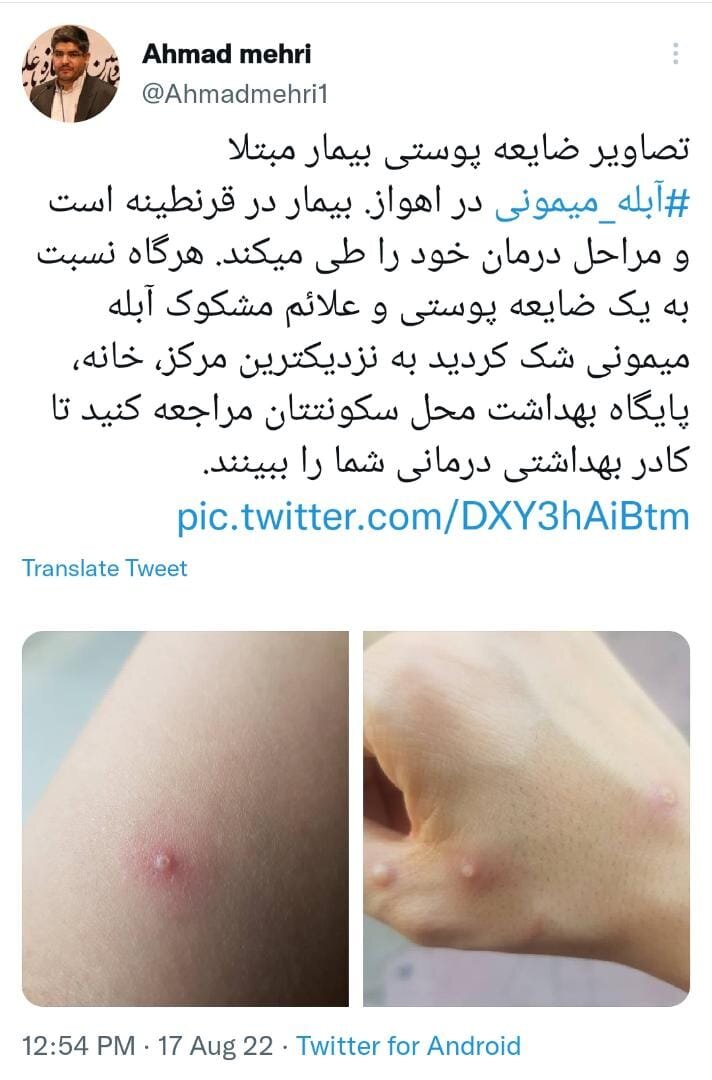 قرنطینه بیمار مبتلا به آبله میمونی در اهواز