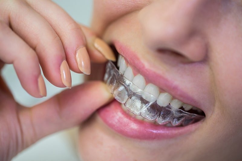 ارتودنسی شفاف به صرفه ترین روش مرتب کردن دندان هاست