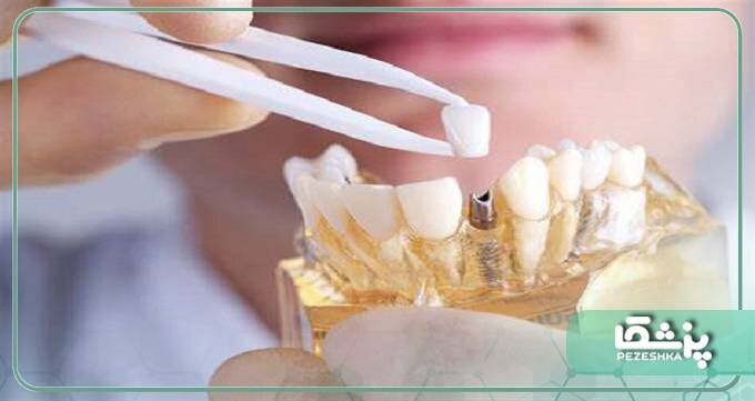 هزینه ایمپلنت دندان در سال 1401چقدر است ؟
