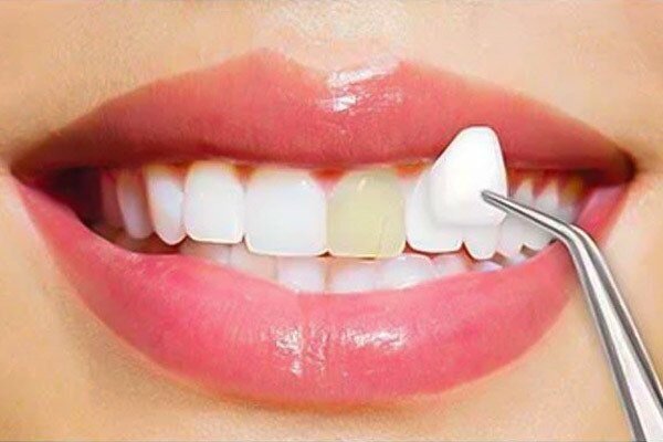 لمینت یا کامپوزیت دندان: مزایا و عوارض هر کدام