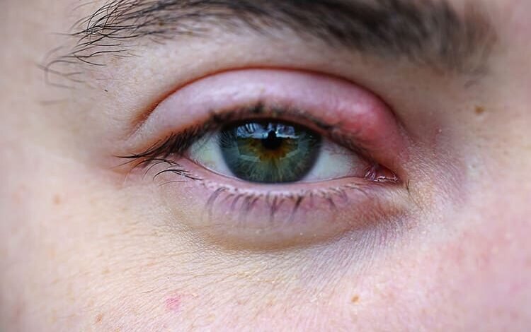 یک تیر دو نشان! درمان بلفاریت و تخلیه چربی زیر چشم