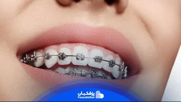 براکت ارتودنسی چیست؟ | قیمت و بهترین نوع آن براکت ارتودنسی چیست؟ | قیمت و بهترین نوع آن
