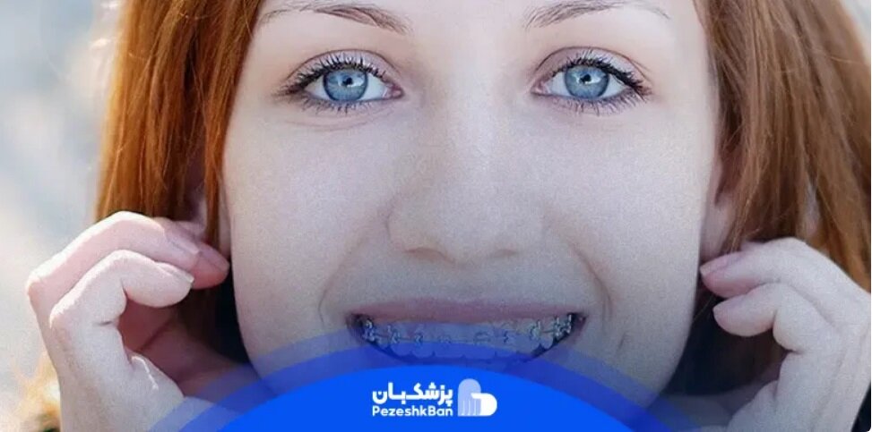 کش براکت ارتودنسی
