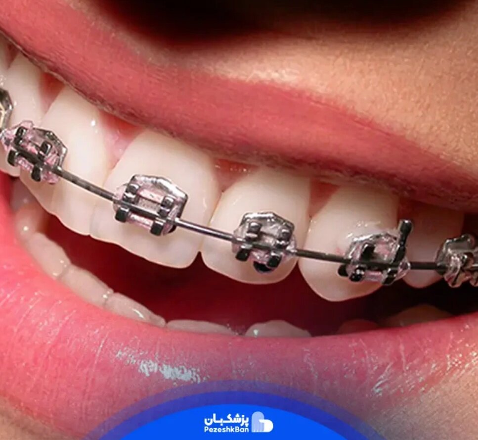 قیمت براکت ارتودنسی