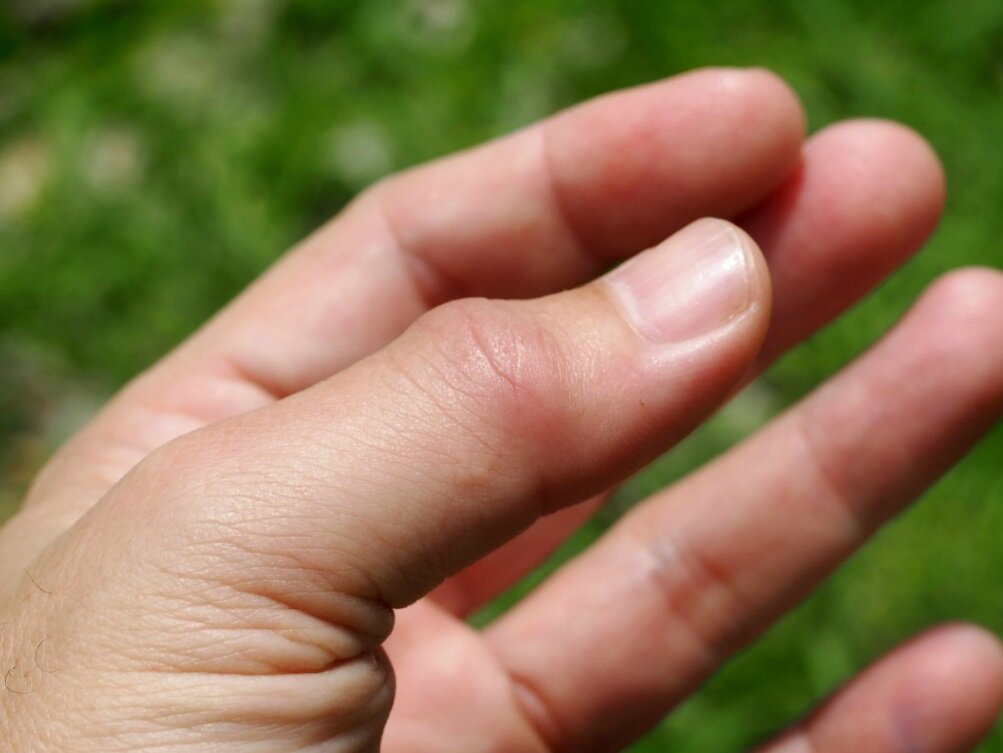 علت ورم انگشتان دست و پا + درمان و کاهش تورم