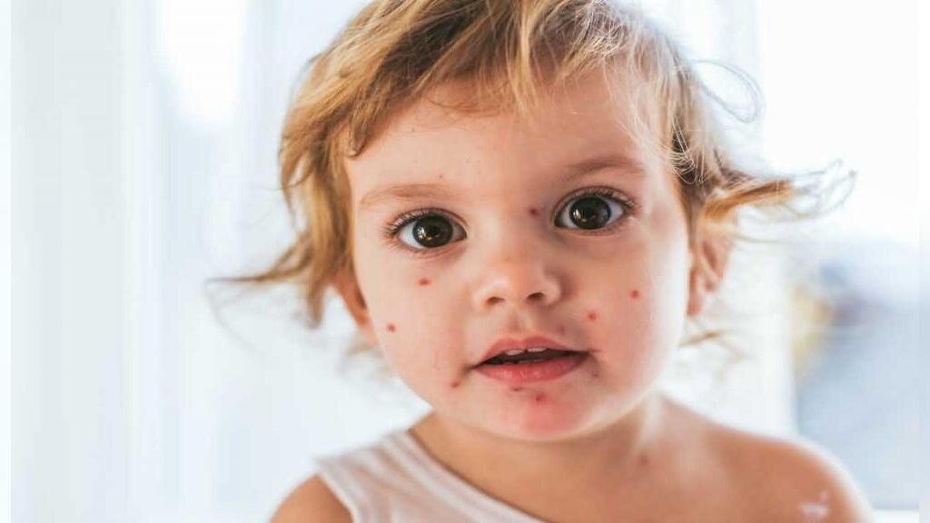 افزایش شیوع ابتلا به سرخک در کشور