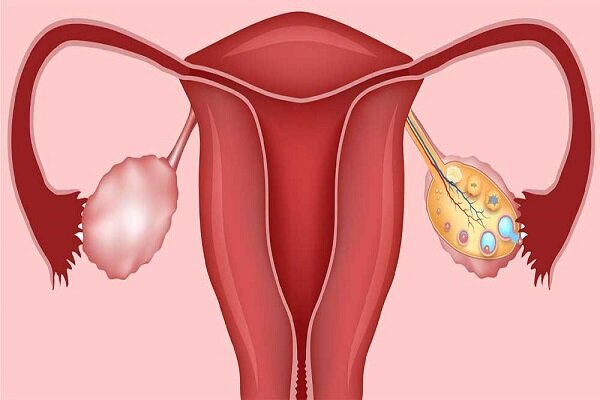 اهمیت درمان تنبلی تخمدان در زنان 