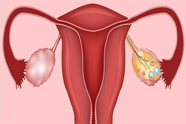 اهمیت درمان تنبلی تخمدان در زنان