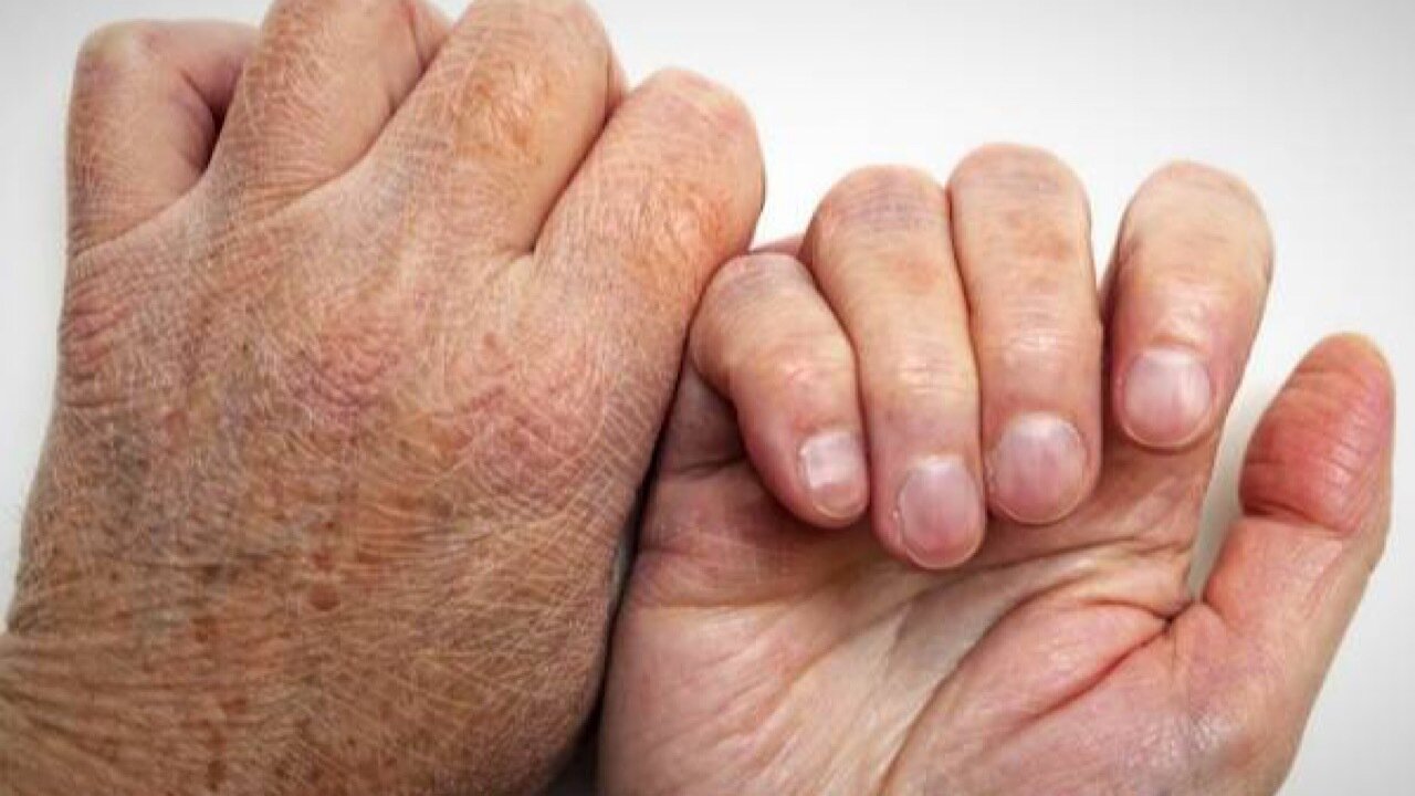 بيماري جذام