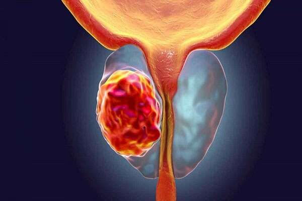 سرطان پروستات