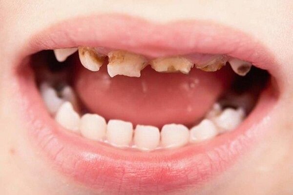 چگونه کودکان را در دندانپزشکی کنترل کنیم؟