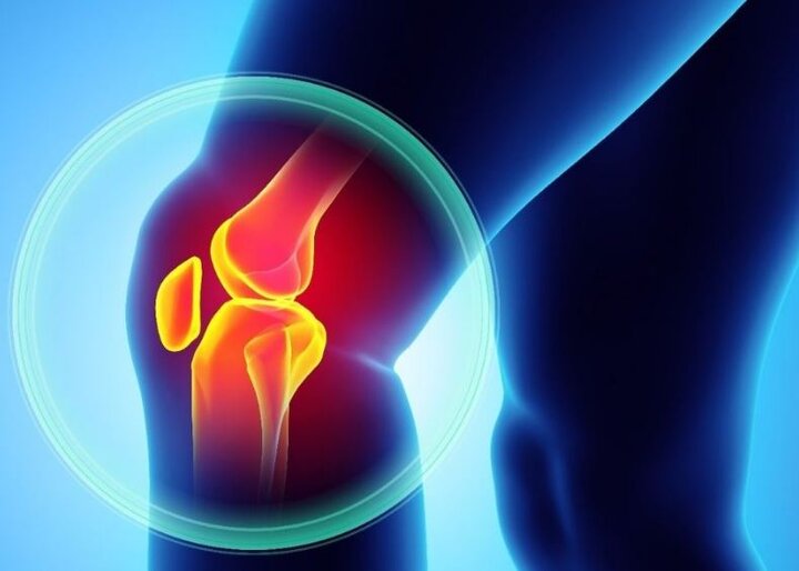 درمان آرتروز زانو در تهران درمان آرتروز زانو در تهران