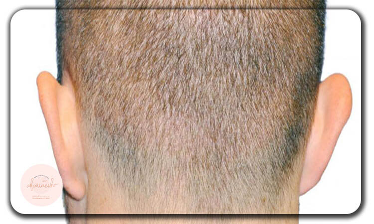 کاشت مو با بانک مو ضعیف