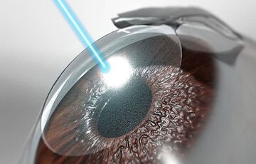 آشنایی با عمل لیزیک چشم توسط متخصص لیزیک
