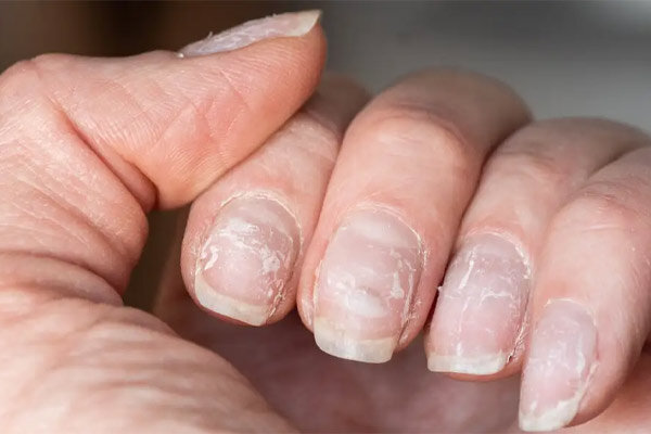 لکه سفید روی ناخن ناشی از کمبود چه ویتامینی است؟