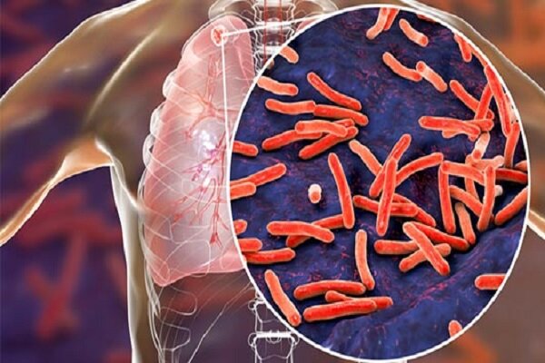 بیماری سل چیست و چرا هنوز مهم است؟ | ایران در مسیر حذف بیماری سل + بررسی آمار و چالشها