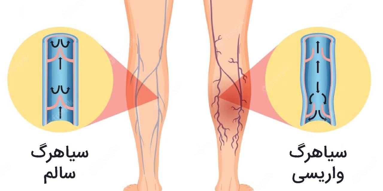 نشانههایی از زنگ خطر واریس و عوارض آن