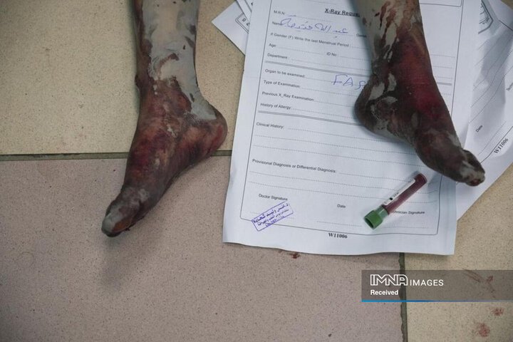 یک فلسطینی مجروح در بمباران اسرائیل در بیمارستان دیرالباله، در نوار غزه، در 2 نوامبر 2023 
