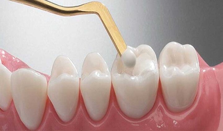 معرفی سه ماده مهم گوتا، امالکپ و کامپوزیت در دندانپزشکی