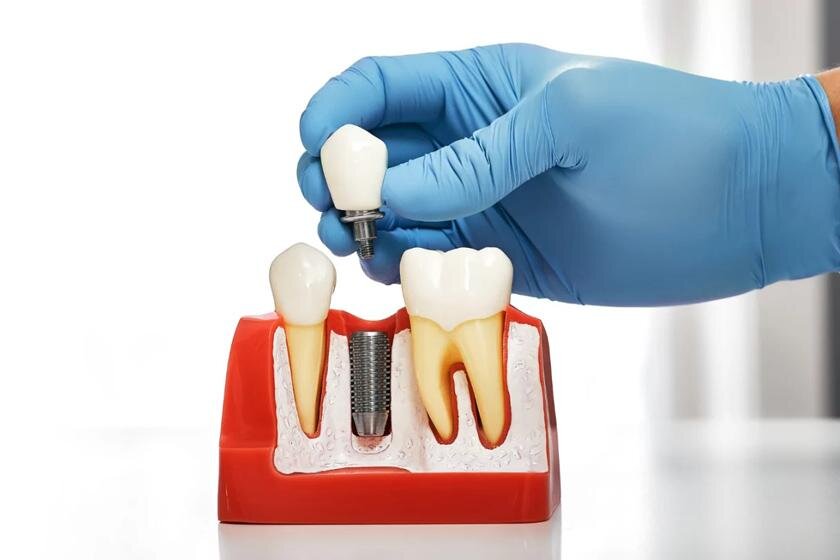 طول عمر و ماندگاری ایمپلنت چقدر است؟