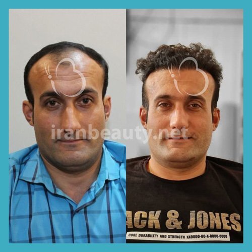 کاشت مو به روش SUT چیست و چقدر هزینه دارد ؟