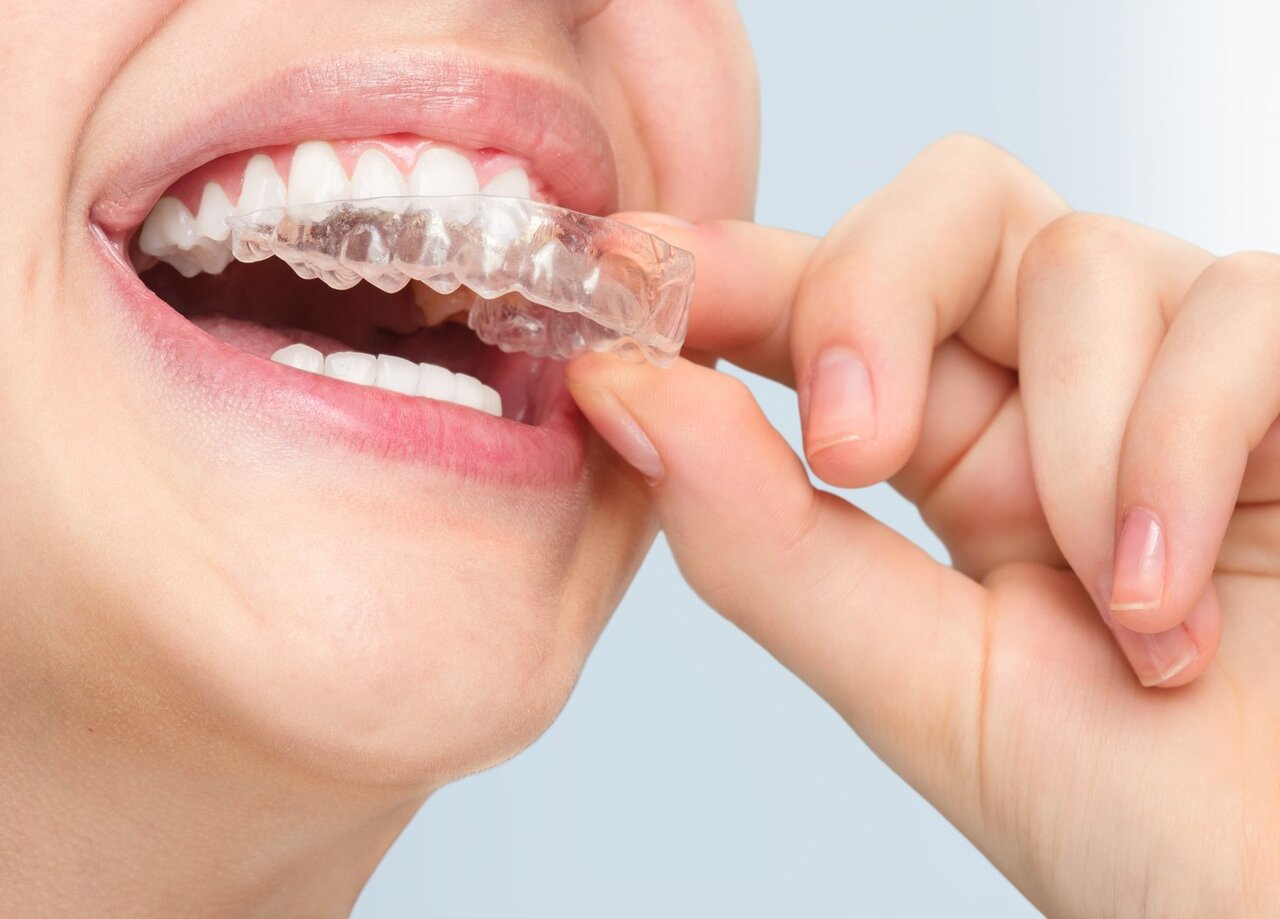 چگونه دندان های خود را بدون سیم های فلزی مرتب کنیم؟