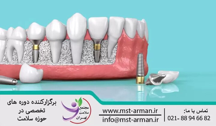 برگزاری اولین دوره ایمپلنت تخصصی در خاورمیانه برگزاری اولین دوره ایمپلنت تخصصی در خاورمیانه