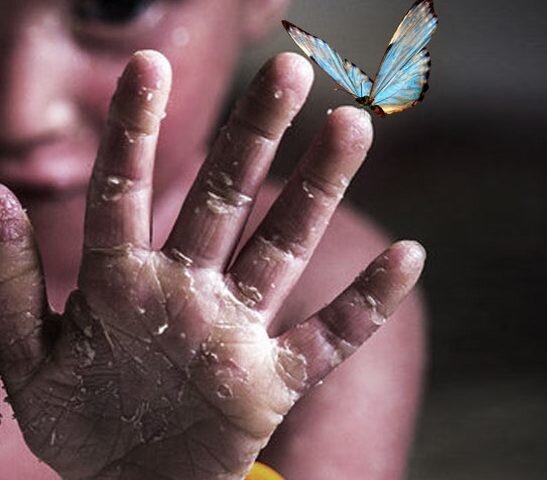 چتر حمایت بر سر بیماران خاص و صعبالعلاج