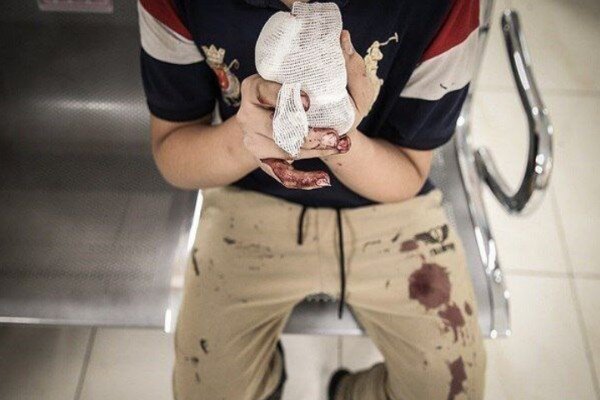 انفجار ترقه‌ در دست یک جوان مرندی