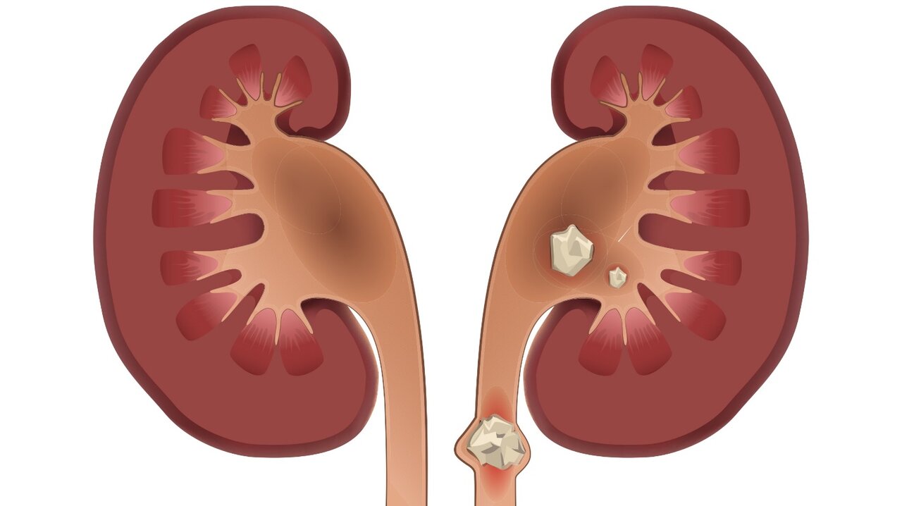 نشانه های سنگ کلیه چیست و چه درمان هایی دارد؟