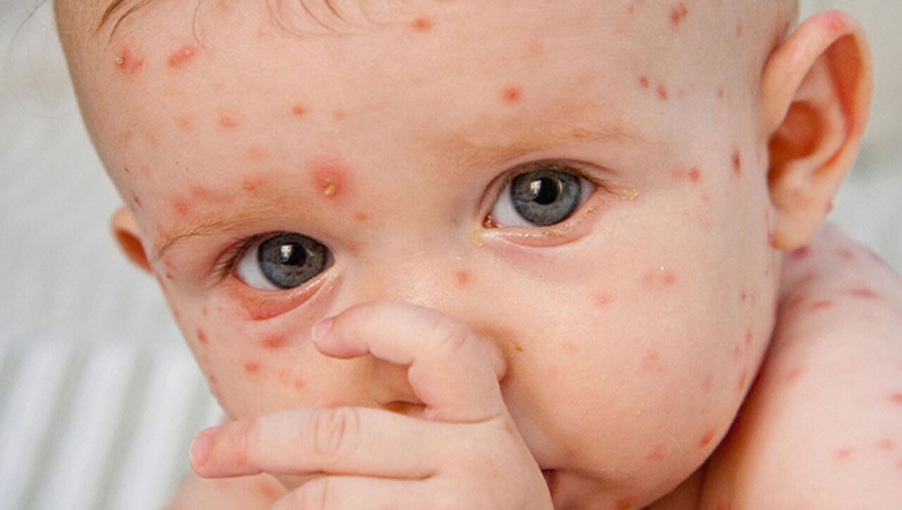 آبله مرغان و مراقبتهای آن