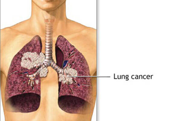 آیا سرفه مداوم با سرطان ریه در ارتباط است؟