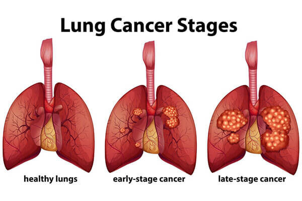 آیا سرفه مداوم با سرطان ریه در ارتباط است؟