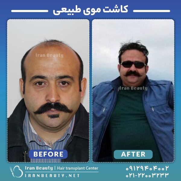 کاشت مو به روش SUT