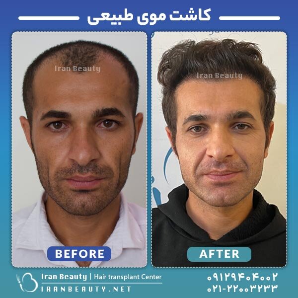 کاشت مو به روش SUPER FUE