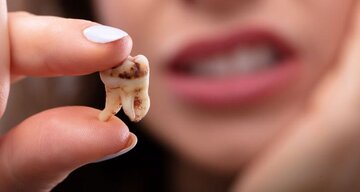 درمان پوسیدگی دندان و تشخیص آن: رویکردها و نوآوری‌ها