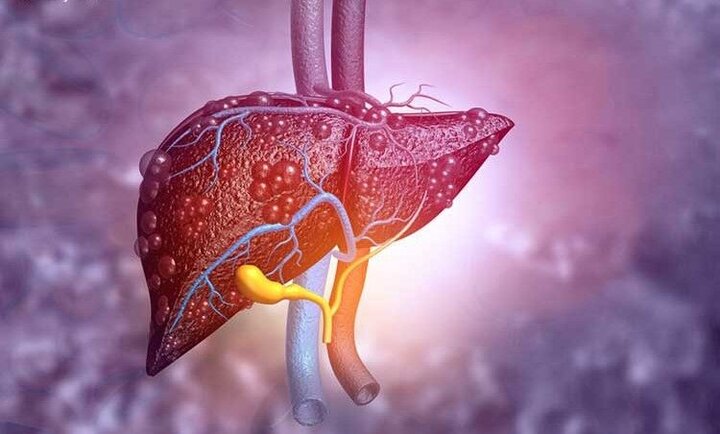ابتلاء به بیماری کبد چرب با تجمع چربی در بدن / ۱۰ درصد بیماران اضافه وزن ندارند