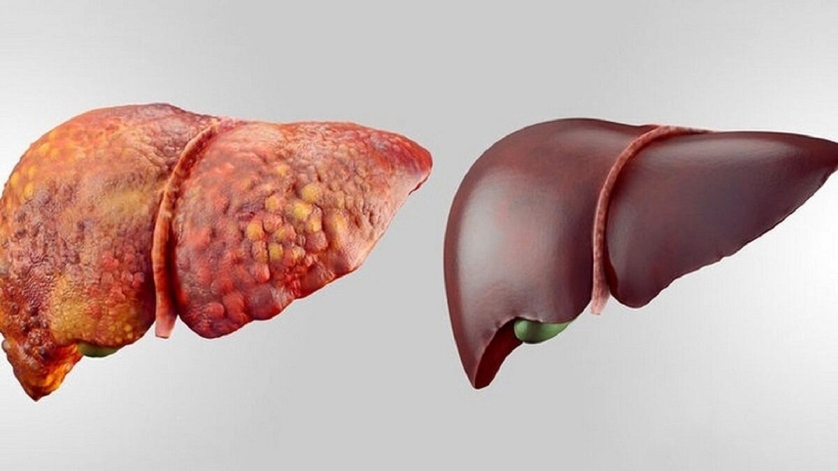 علائم انواع کبد چرب را بشناسید+ راهکار درمان در طب‌ سنتی