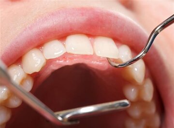 کمبود کدام ویتامین ها باعث افزایش پوسیدگی دندان ها می شود ؟