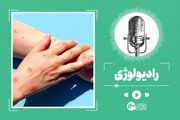 آشنایی با آبله میمونی + علایم و نحوه پیشگیری